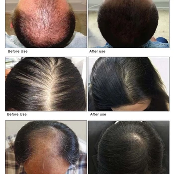 Средство за растеж на косата с джинджифил Средство Срещу Косопад Козметични Етерични Масла за Подхранване на Кожата на главата Възстановяват Косата Истончают Сухи Възстановяват Грижи